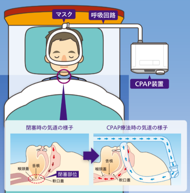 SAS（睡眠時無呼吸症候群）とCPAP（持続気道陽圧）療法について